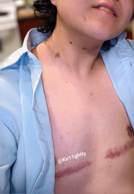 How do I look? 😘 #hot #sexy #nude #trans #ftm #queer #hickies #horny https://t.co/Mmcfh586dy<a href="/tag/hot"class="tags">#hot</a><a href="/tag/sexy"class="tags">#sexy</a><a href="/tag/nude"class="tags">#nude</a><a href="/tag/trans"class="tags">#trans</a><a href="/tag/ftm"class="tags">#ftm</a><a href="/tag/horny"class="tags"><span>#horny</span></a><a href="/tag/queer"class="tags"><span>#queer</span></a><a href="/tag/hickies"class="tags"><span>#hickies</span></a>