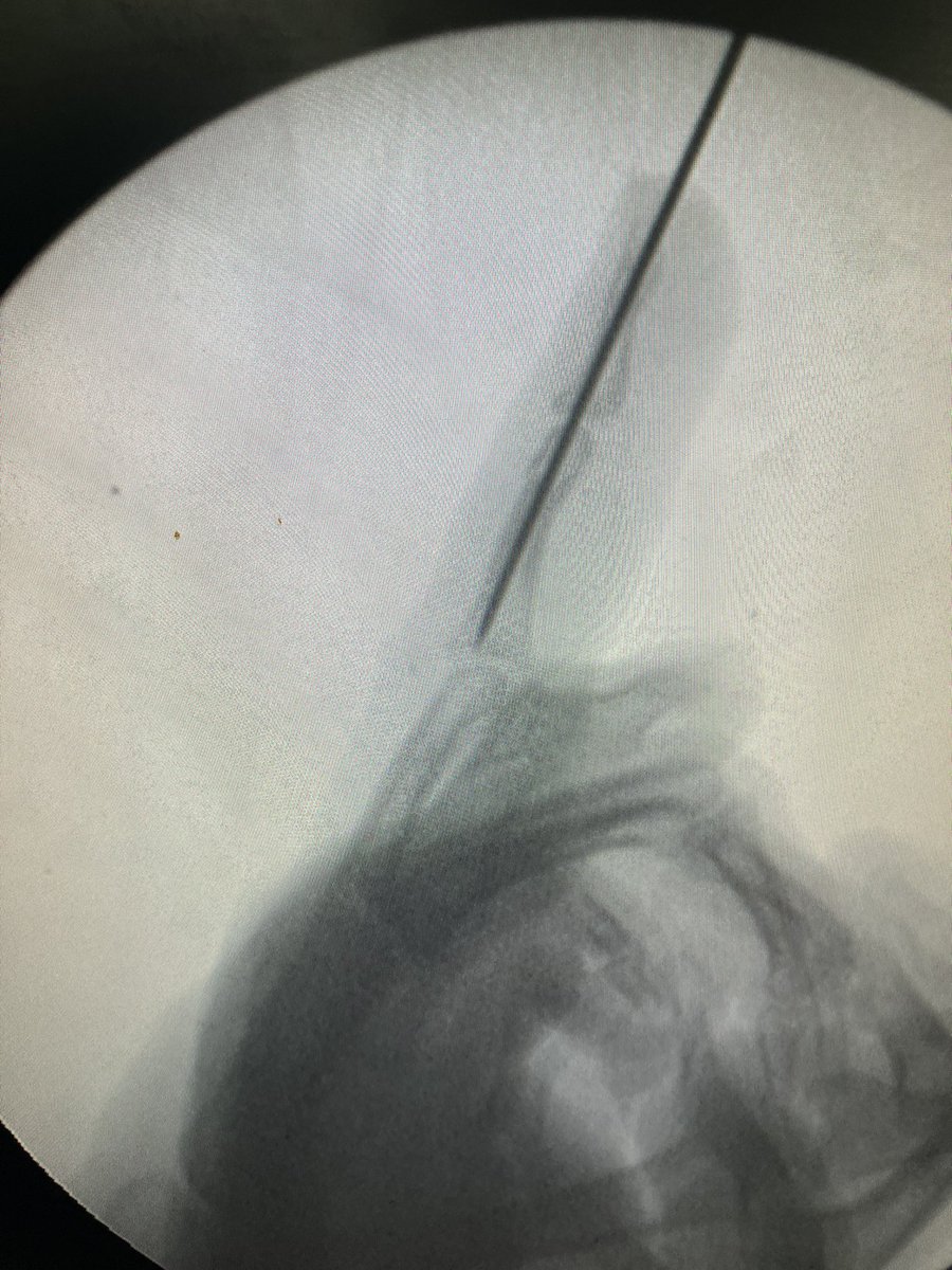 Using the kapandji technique to reduce and fix a middle phalanx neck fracture. #handsurgery