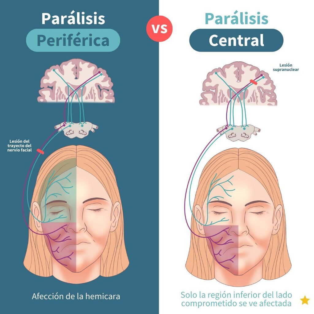 CursosImas's tweet photo. 📌 Rápido recordatorio de la parálisis central y periférica💡
🏷️ Guarda y comparte con tus compañeros
#ENARM #ExamenMIR #medicina #medicos #MIP #estudiantesdemedicina #enfermeria #internadomedico #apuntesmedicos #notasmedicas #neurologia #paralisisfa… https://t.co/YNjWUgAIiW https://t.co/aW3uJRWbYo