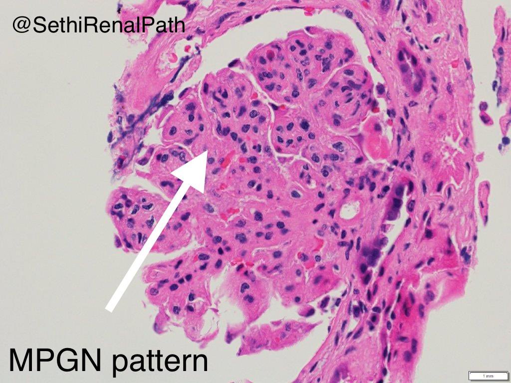 SethiRenalPath's tweet photo. Pronase IF to the rescue

LM: MPGN=mesangial &amp; endocapillary hypercellularity, double contours, lobular tufts.

IF: All medulla.

Did IF on paraffin: IgG+++ kappa+++ lambda neg

Dx: Proliferative GN with monoclonal Ig (PGNMID), IgG kappa.

68 yr-old, rise in Cr, UA=RBC &amp; protein. https://t.co/scwAf3Dzf7