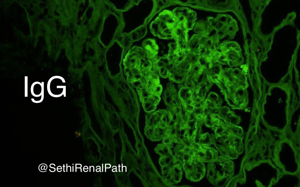 SethiRenalPath's tweet photo. Pronase IF to the rescue

LM: MPGN=mesangial &amp; endocapillary hypercellularity, double contours, lobular tufts.

IF: All medulla.

Did IF on paraffin: IgG+++ kappa+++ lambda neg

Dx: Proliferative GN with monoclonal Ig (PGNMID), IgG kappa.

68 yr-old, rise in Cr, UA=RBC &amp; protein. https://t.co/scwAf3Dzf7