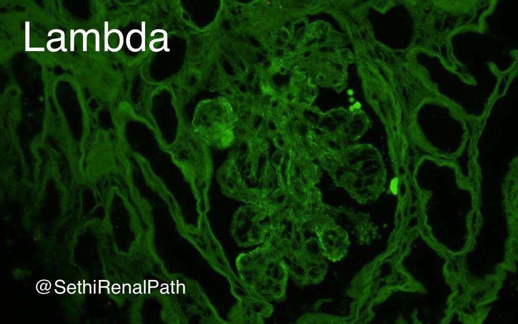 SethiRenalPath's tweet photo. Pronase IF to the rescue

LM: MPGN=mesangial &amp; endocapillary hypercellularity, double contours, lobular tufts.

IF: All medulla.

Did IF on paraffin: IgG+++ kappa+++ lambda neg

Dx: Proliferative GN with monoclonal Ig (PGNMID), IgG kappa.

68 yr-old, rise in Cr, UA=RBC &amp; protein. https://t.co/scwAf3Dzf7