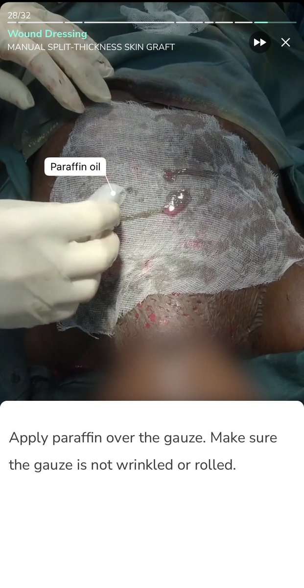 APierroMedicine's tweet photo. To any pre-med, especially pre-surgery students! Download the free app Touch Surgery, where you can participate in virtual surgery simulations. Today I learned the procedure for a skin graft! #WISE #WISE2023 @YHSMrsMero https://t.co/hCIfU32MPd