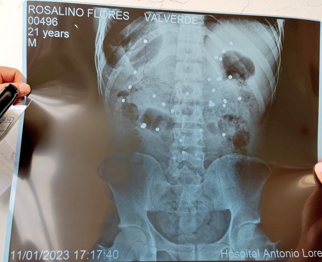 Vero_Mendoza_F's tweet photo. 2️⃣2️⃣ años tenía Rosalino Florez, estudiante de gastronomía 
3️⃣6️⃣ perdigones de plomo le disparó la Policía por la espalda 
6️⃣ lograron sacarle en el hospital en Cusco
7️⃣0️⃣ días resistió antes de dar el último suspiro
💔
Solidaridad con su familia. 
Que su muerte no quede impune. https://t.co/vc1d8diCZG