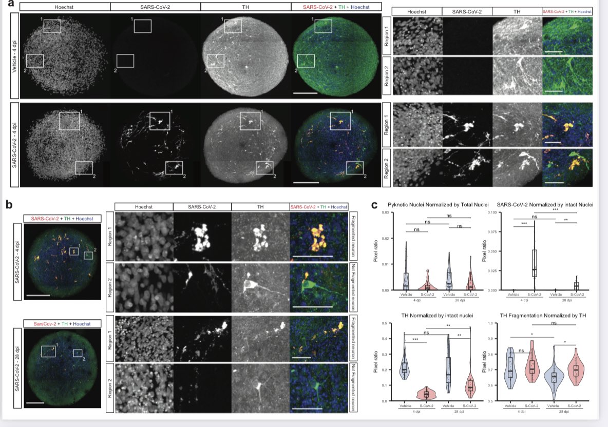 A new study evaluated the effects of SARS2 infection in prolonged culture of midbrain organoids, showing that the virus induces changes in gene expression, and fragmentation and loss of dopaminergic neurons. 1/