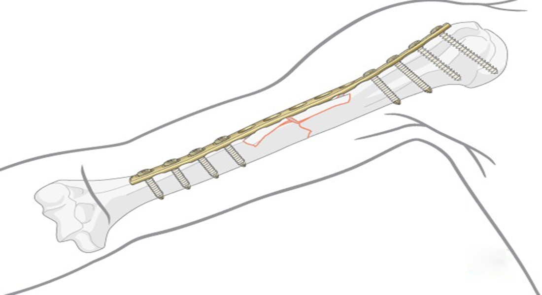 siorasurgicals's tweet image. The bone Screw size is dependent on the size &amp;amp; type of plate used. A small plate will typically be used for a small bone, which allows space only for a screw of a smaller size.
siiora.com/blogs/kinds-of…
#boneScrew #Plating #siora #fibulafracture #instruments #medical #health #pain