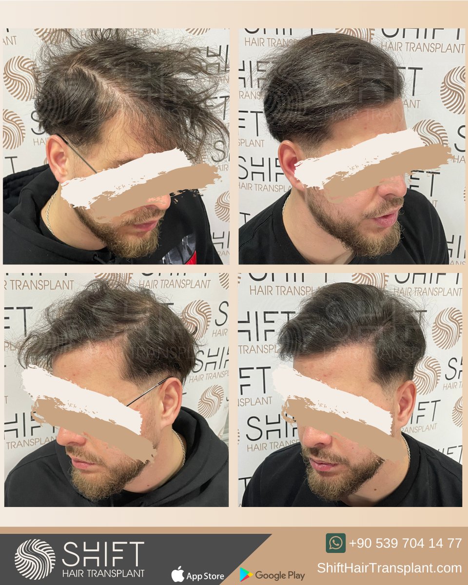 shifthairtr's tweet image. Before and after the micropigmentation for density in Turkey with SHIFT Hair in Istanbul

#micropigmentation #scalpmicropigmentation #micropigmentationturkey #micropigmentationturkiye #micropigmentationistanbul