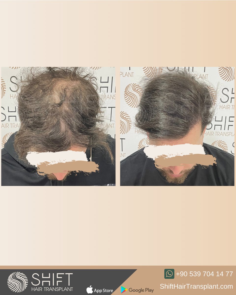shifthairtr's tweet image. Before and after the micropigmentation for density in Turkey with SHIFT Hair in Istanbul

#micropigmentation #scalpmicropigmentation #micropigmentationturkey #micropigmentationturkiye #micropigmentationistanbul