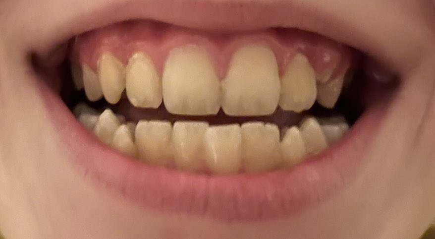 prouddmama's tweet photo. Wat houd mij bezig... De #myobrace ik snap niet dat er zoveel geld aan een #beugel word betaald als een kind met het dragen van een #myobrace #schevetanden kan voorkomen.. Vooral mensen in de #bijstand met kinderen kunnen zo geholpen worden. Eerste foto 4 mnd geleden 2e nu.. https://t.co/95Z7sOzD1H