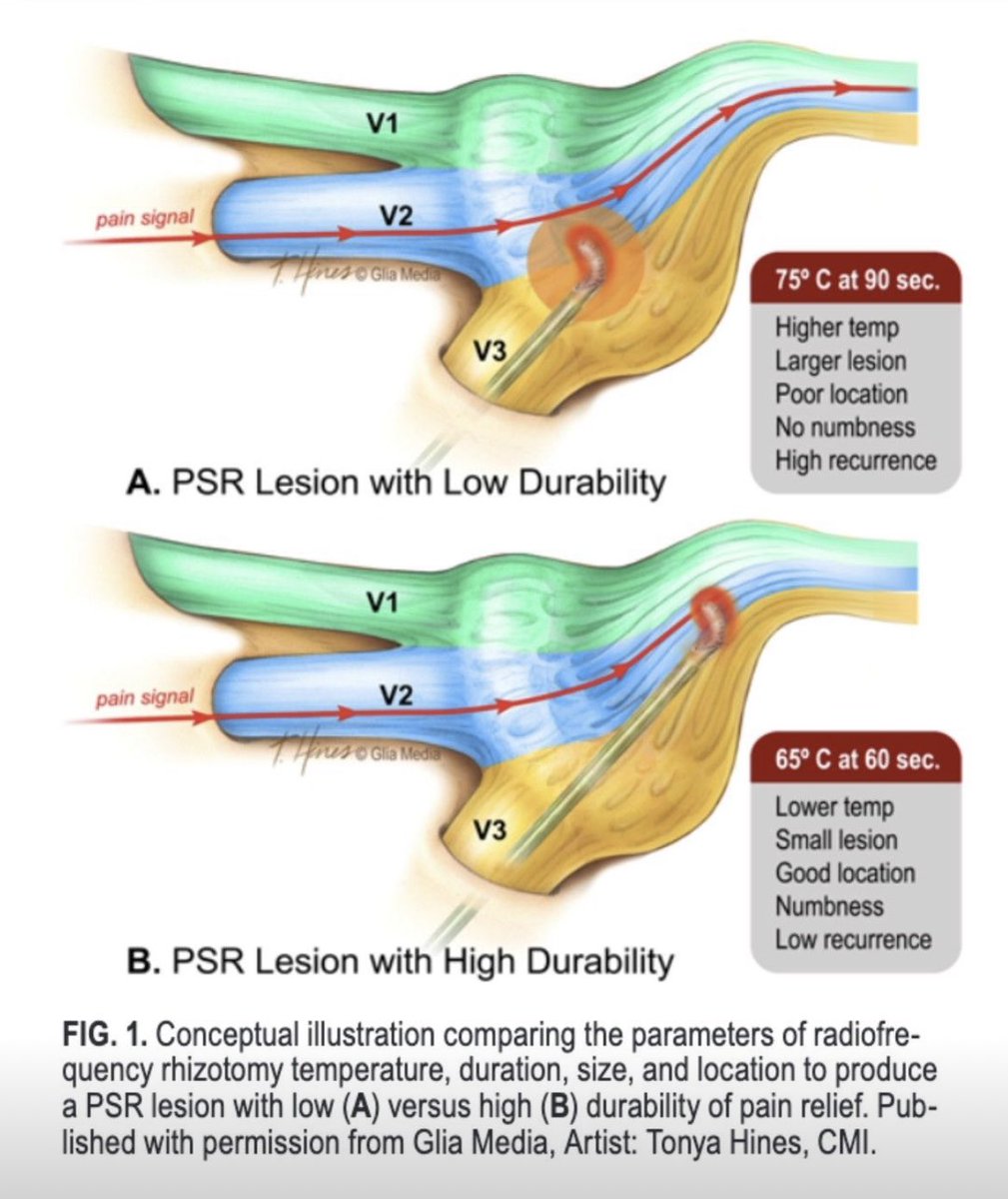 tariqtramboo's tweet image. Important information for pain physicians who do #Trigeminal neuralgia RFA for facial pain.

It is the precision and not the higher temperatures that required for the longterm pain relief. #TrigeminalNeuralgia