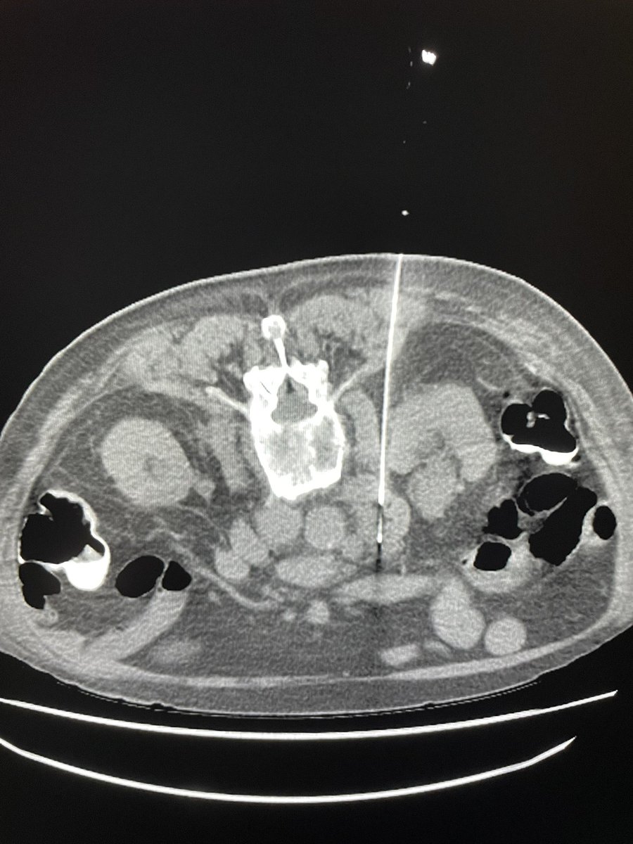 John Pavlus, MD (@drjohnpavlus) on Twitter photo 🎯 🥷
When the patient absolutely needs a biopsy and is high risk of bleeding…pick the path of least resistance (i.e., fat is your friend)
🎯 🥷 #irninja #MedEd #irad <a href="/SIRspecialists/">Society of Interventional Radiology</a> <a href="/SIRRFS/">SIR RFS</a> <a href="/SIR_ECS/">SIR ECS</a> <a href="/bayouteazy/">Tyler Sandow</a> <a href="/LacayoMD/">Eduardo Lacayo, MD</a> 🎯 🥷
When the patient absolutely needs a biopsy and is high risk of bleeding…pick the path of least resistance (i.e., fat is your friend)
🎯 🥷 #irninja #MedEd #irad <a href="/SIRspecialists/">Society of Interventional Radiology</a> <a href="/SIRRFS/">SIR RFS</a> <a href="/SIR_ECS/">SIR ECS</a> <a href="/bayouteazy/">Tyler Sandow</a> <a href="/LacayoMD/">Eduardo Lacayo, MD</a>