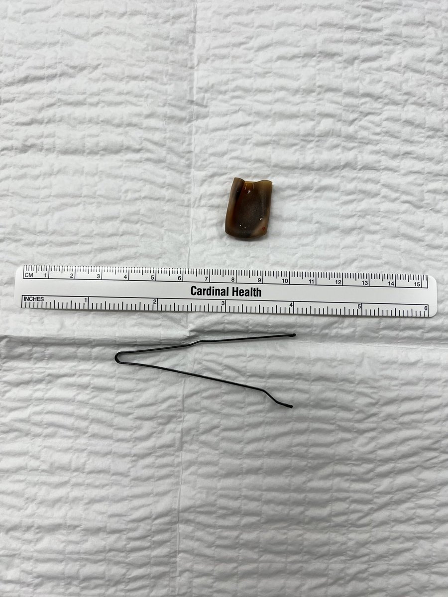 KincadeMD's tweet photo. @gpohlmanmd Truth…
This was what I had the privilege to encounter last Saturday night…
Bobby pin stuck when used to try to retrieve rubber cap (which had been “lost” 9 months ago…) https://t.co/Tb2879ecNS