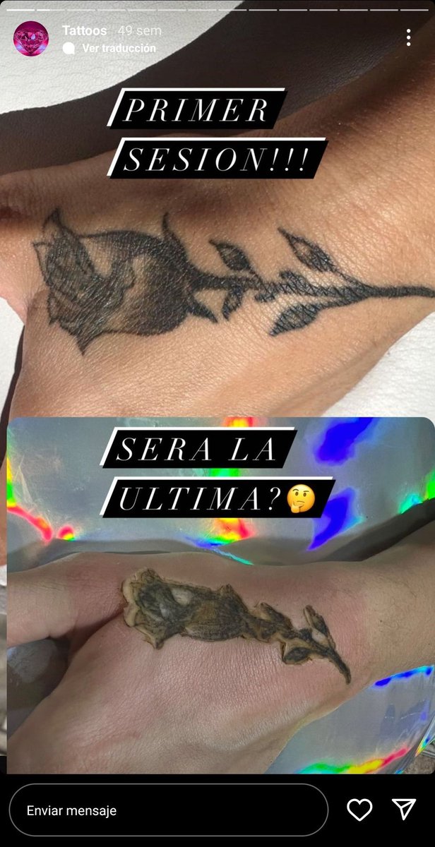 rickyedit's tweet photo. una clínica en redes presume de borrar tatuajes en una sola sesión. lo que no dicen es que te borran medio cuello también. acojonante. https://t.co/lTUsy0Tdap