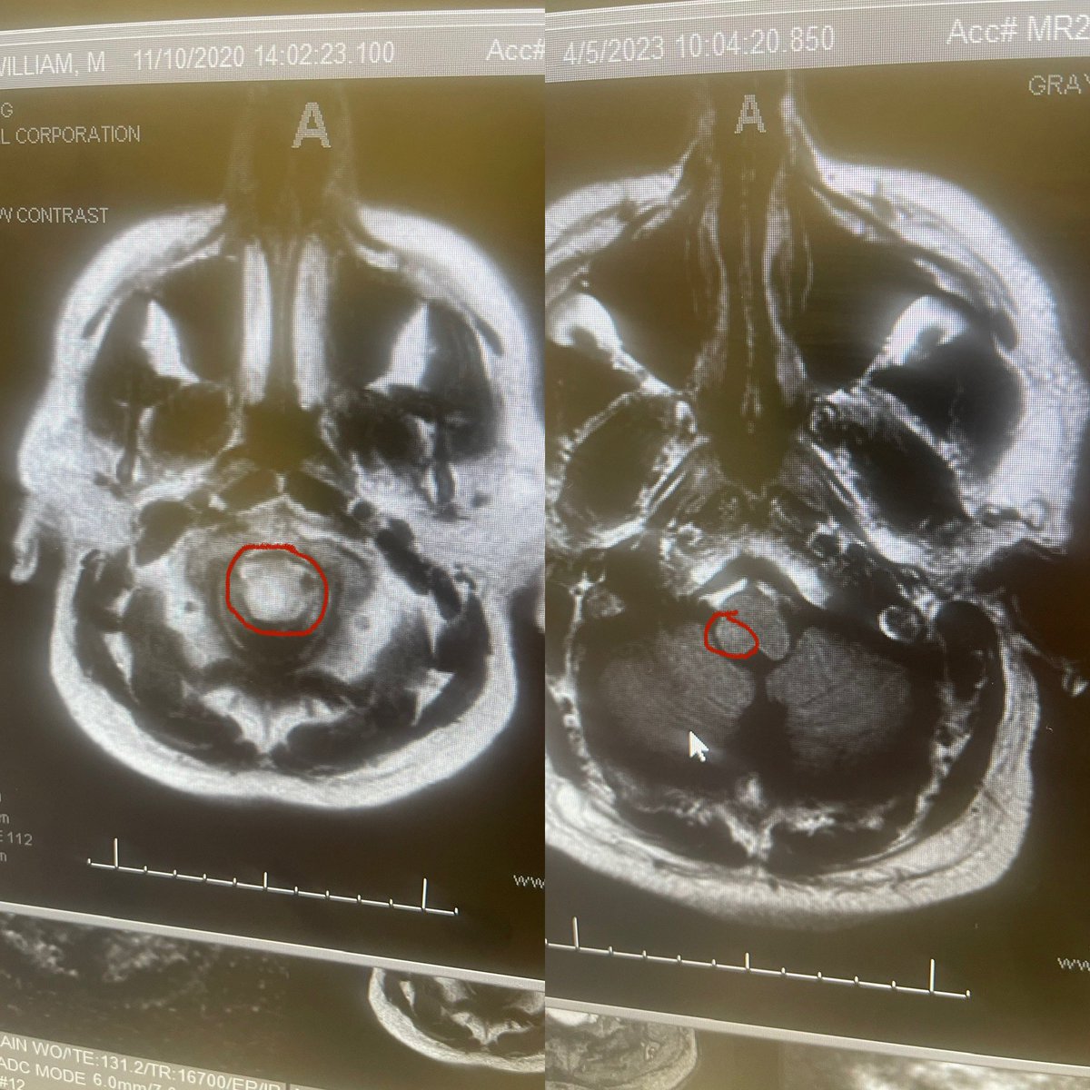 michael_graydon's tweet photo. Scans look fantastic! He said it use to cover 2/3 of my brainstem and now he can barely see any at all 🙌🏽 I guess I’ve officially used my one time for life! https://t.co/hjeHDZH5GE