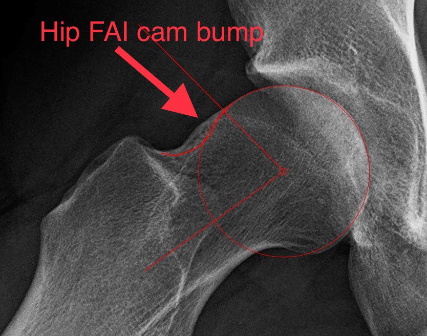 Dr. Derek Ochiai on Twitter "Unlike many Sports Medicine surgeries, 