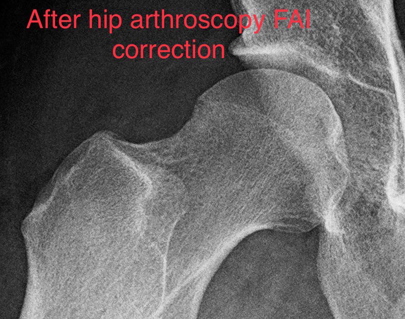 Dr. Derek Ochiai on Twitter "Unlike many Sports Medicine surgeries, 