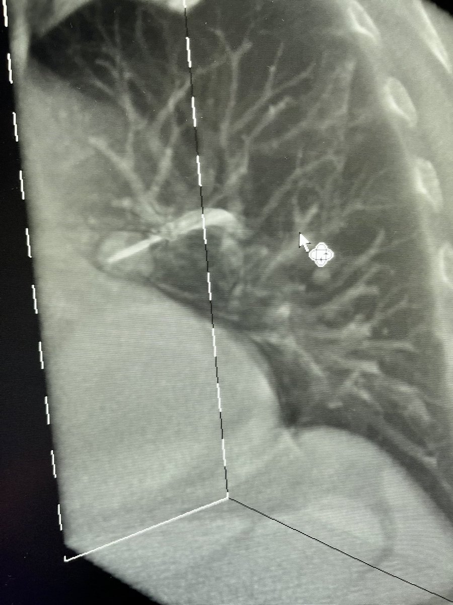 Bhadra & Condra CBCT Bronchoscopy tweet media