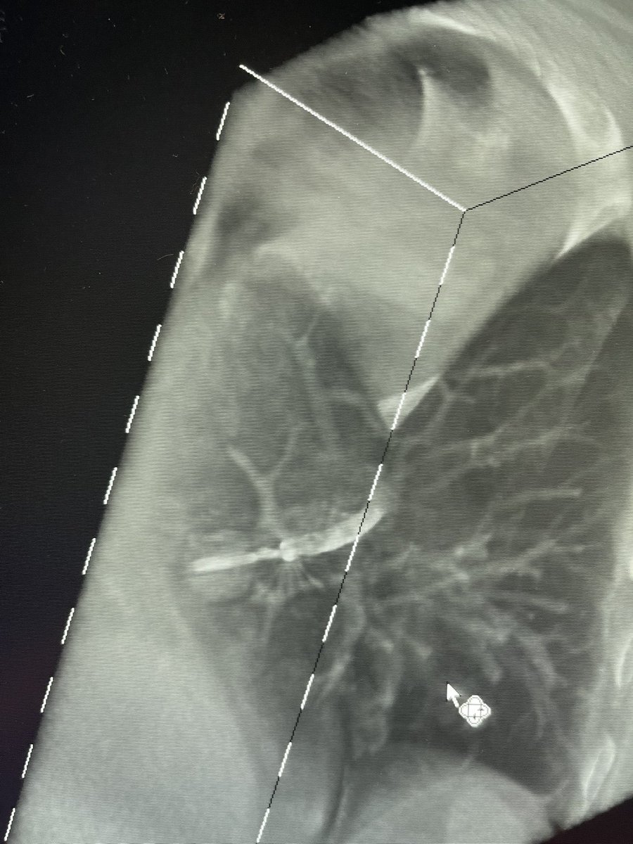 Bhadra & Condra CBCT Bronchoscopy tweet media