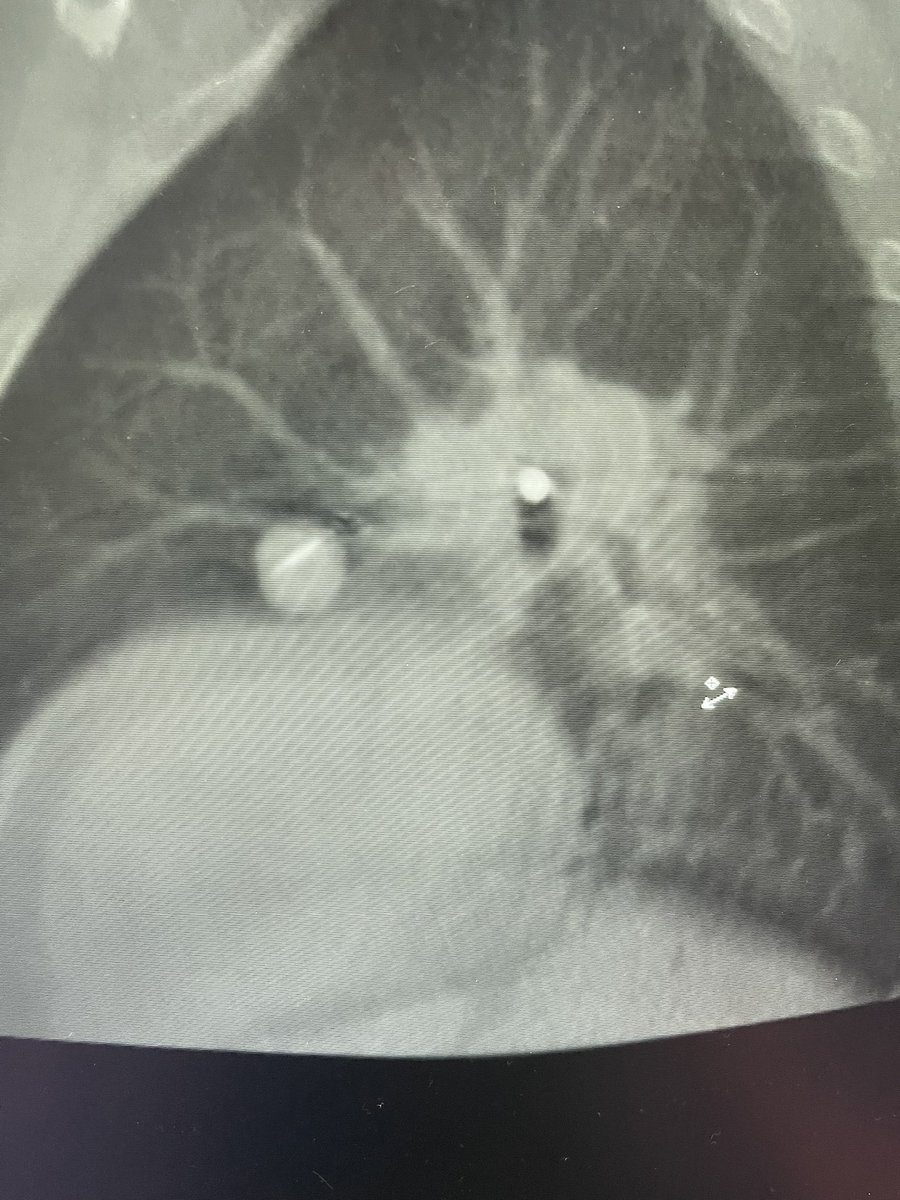 Bhadra & Condra CBCT Bronchoscopy tweet media