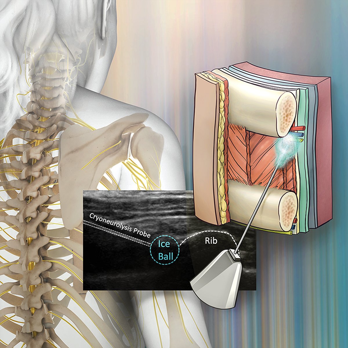After breast surgery, patients receiving paravertebral #anesthetic blocks plus intercostal #cryoneurolysis reported less pain on postoperative day 2 compared to those receiving the same blocks without cryoneurolysis. Learn more: ow.ly/ORjU50NBCgL