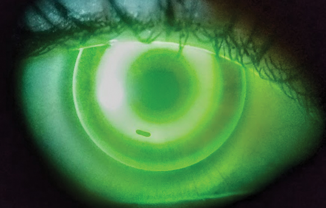 Ortho-K Lenses Have Minimal Effect on Ocular Surface ✅
No significant difference was observed in meibomian gland loss or noninvasive average tear film break-up time.
reviewofoptometry.com/article/orthok…

#optometry #eyecare #ocularsurface #cornea