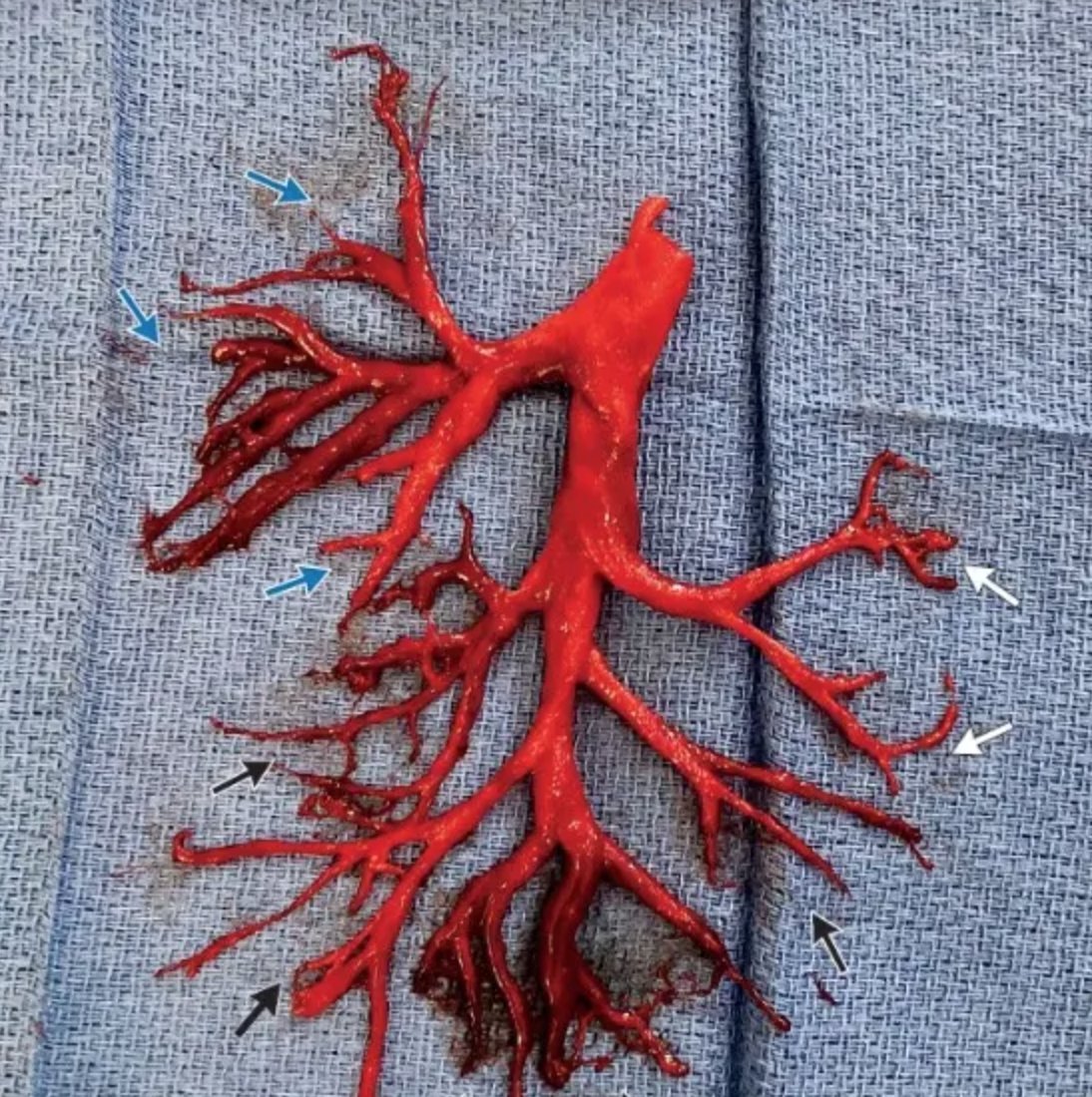 OGdukeneurosurg's tweet image. Nature is cruel and beautiful: Man started anticoagulation, had hemoptysis, &amp;amp; expectorated a perfect cast of the right bronchial tree. @Nejm
