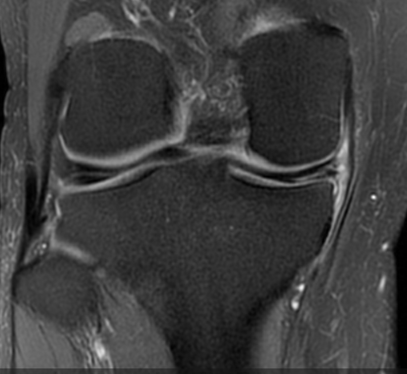 DrNickColyvas's tweet photo. 55 year old, recreational athlete, No acute trauma, mostly medial pain, some lateral.  Varus knee(s), medial and lateral meniscus tears.  Whats the #orthtwitter doing here ? https://t.co/BjMBUbRbeN