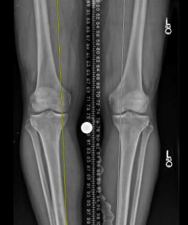DrNickColyvas's tweet photo. 55 year old, recreational athlete, No acute trauma, mostly medial pain, some lateral.  Varus knee(s), medial and lateral meniscus tears.  Whats the #orthtwitter doing here ? https://t.co/BjMBUbRbeN