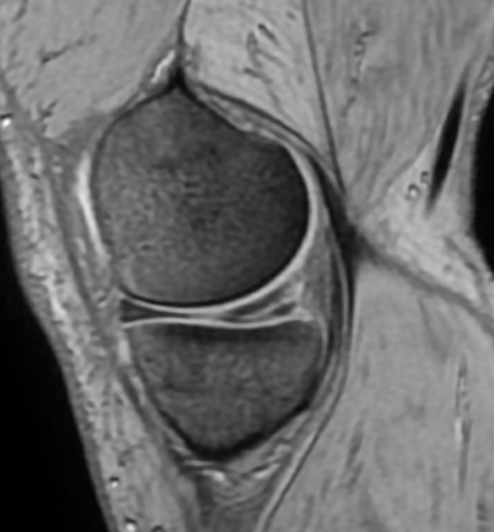 DrNickColyvas's tweet photo. 55 year old, recreational athlete, No acute trauma, mostly medial pain, some lateral.  Varus knee(s), medial and lateral meniscus tears.  Whats the #orthtwitter doing here ? https://t.co/BjMBUbRbeN