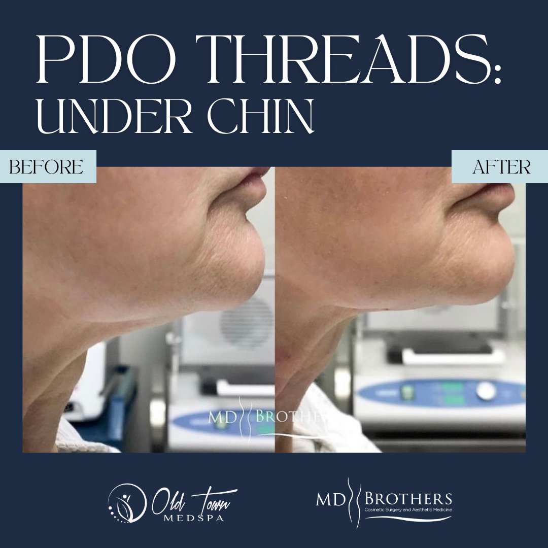 themdbrothers's tweet image. If you&apos;re looking for minor facelift-like results without the invasive procedure or extended downtime, facial threads could be the perfect option for you.
 #facialthreads #pdothreads #minifacelift #facialcontouring #antiagingtreatments #chicagomedspa #oldtownmedspa #mdbrothers