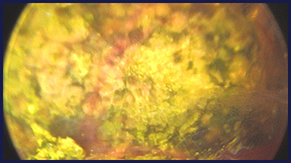 JVIR (@jvirmedia) on Twitter photo Multi-institutional Retrospective Study of Percutaneous Cholangioscopy-Assisted Lithotripsy for Inoperable Calculous Cholecystitis
<a href="/johnsmirnMD/">John Smirniotopoulos</a>
ow.ly/j2v550Numfz Multi-institutional Retrospective Study of Percutaneous Cholangioscopy-Assisted Lithotripsy for Inoperable Calculous Cholecystitis
<a href="/johnsmirnMD/">John Smirniotopoulos</a>
ow.ly/j2v550Numfz