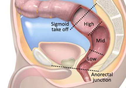 BjsOpen's tweet photo. Rectal🦀not = Sigmoid🦀‼️ Introduction of the sigmoid take-off definition in 🇳🇱 (n=1302) in retrospect resulted in 170 reclassifications Rec➡️Sigmoid &amp; 54% changes in systemic treatment!
https://t.co/hNcjZoqOnM
#some4surgery #colorectalsurgery
#StepUp4CRC @Mcfark @LauraLorenzonMD https://t.co/aTSoMSDk2z