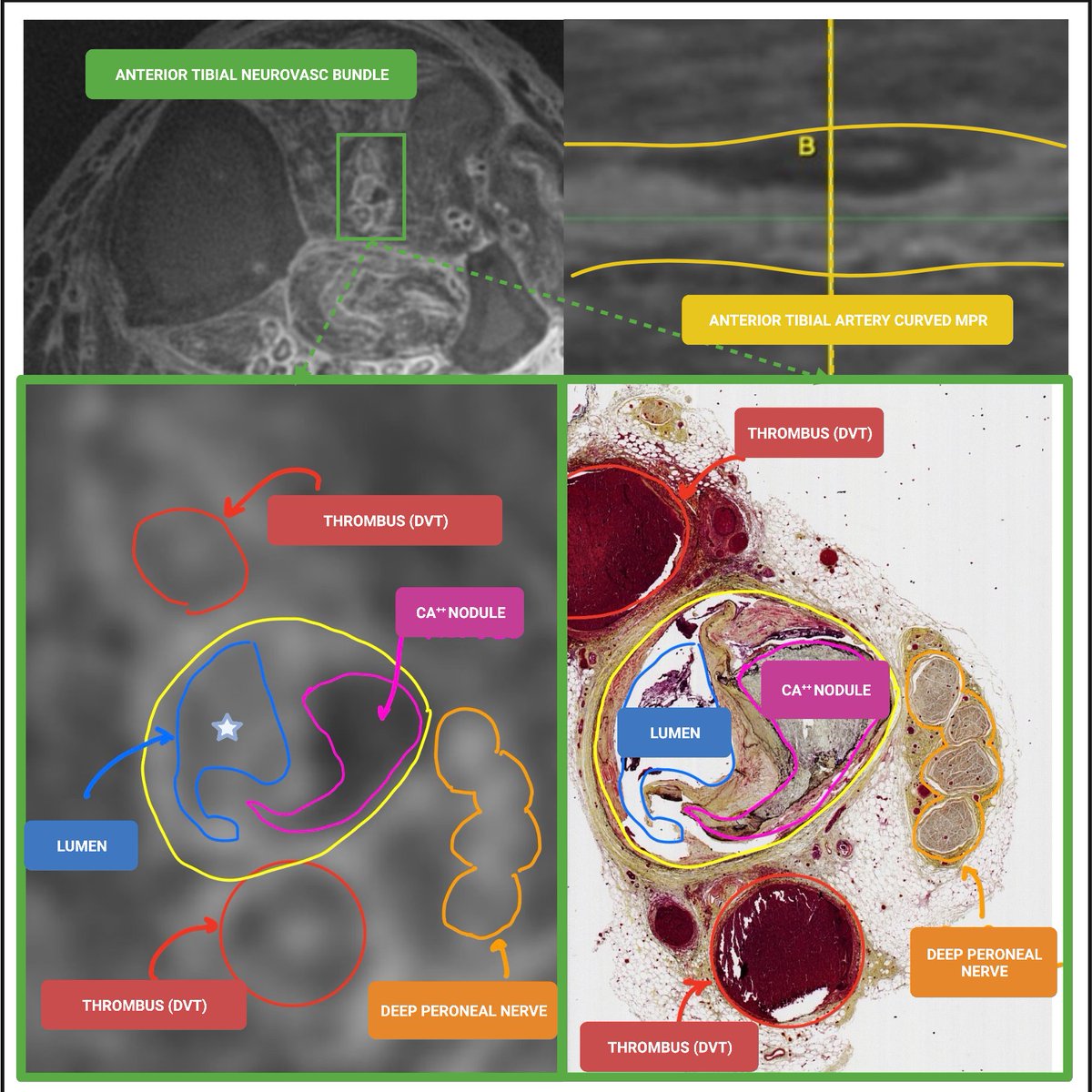 trisharoymd's tweet photo. DUS showed long calcified AT total occlusion, but lesion easily crossed! Ghost lumens exist w patent channels to foot that we can't see, not even on angio. 7T MRI = ghost lumens, plaque, DVTs + nerves in detail we've never seen before. Lets understand PVD better! @AlanLumsdenMD https://t.co/fOn1LnjCfa