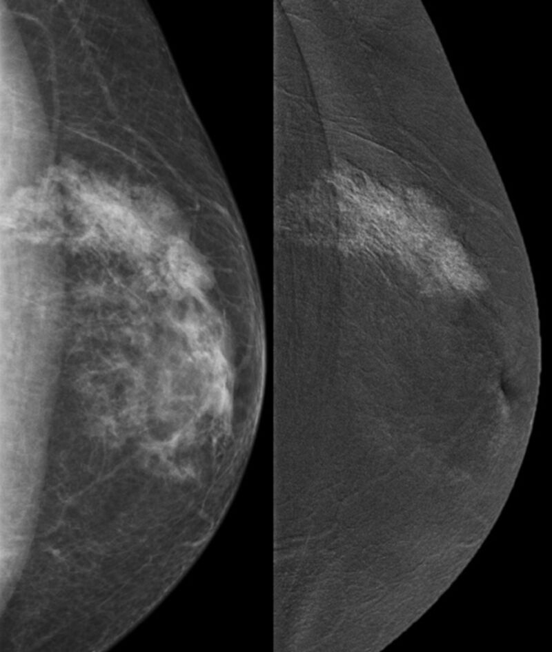 Male breast cancer is rare, but its occurrence has increased. The typical presentation is a palpable mass near the nipple. Mammography and ultrasound are key in the initial assessment. Early detection and treatment lead to better outcomes. #malebreastcancer #invisibles2023