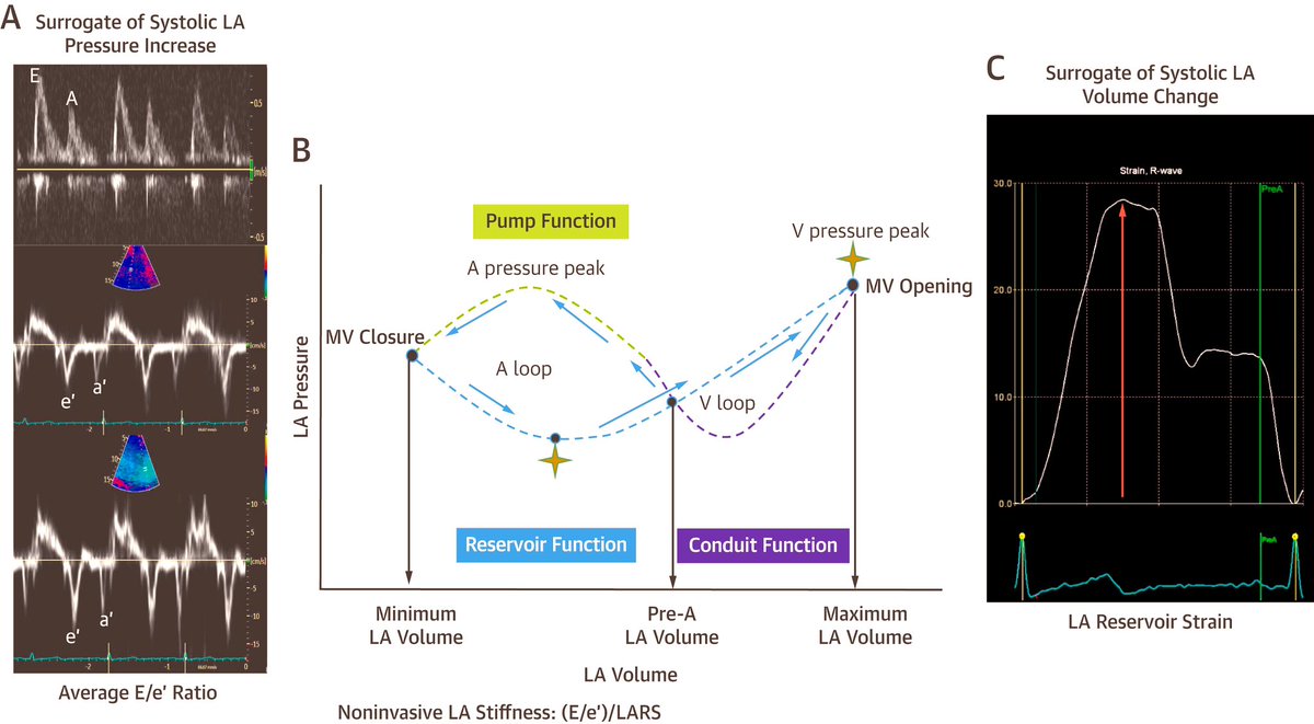Henry Han (@hancardiomd) on Twitter photo Noninvasive measurement of Left Atrial stiffness in #HFpEF patients , applications and future directions
jacc.org/doi/10.1016/j.…
#JACCIM <a href="/JACCJournals/">JACC Journals</a> Noninvasive measurement of Left Atrial stiffness in #HFpEF patients , applications and future directions
jacc.org/doi/10.1016/j.…
#JACCIM <a href="/JACCJournals/">JACC Journals</a>