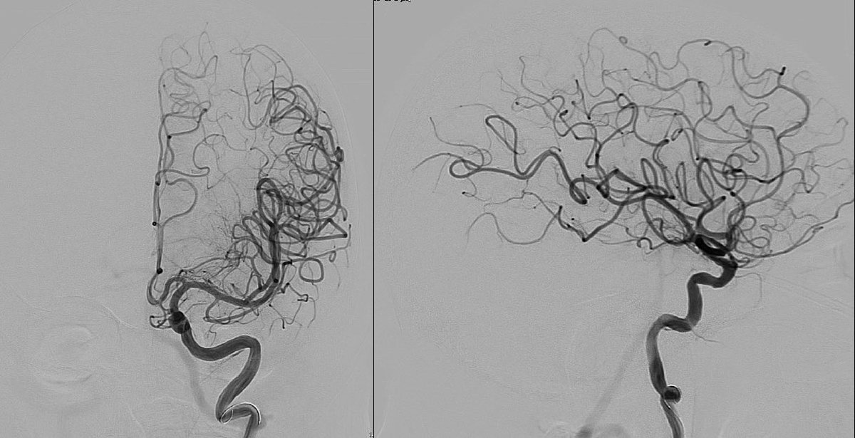 CarlosC74716941's tweet photo. Symptomatic occlusion of the common carotid artery.
A recanalization with angioplasty and stent placement was performed. Thanks @IsaRCaamano https://t.co/QNlGcI619n