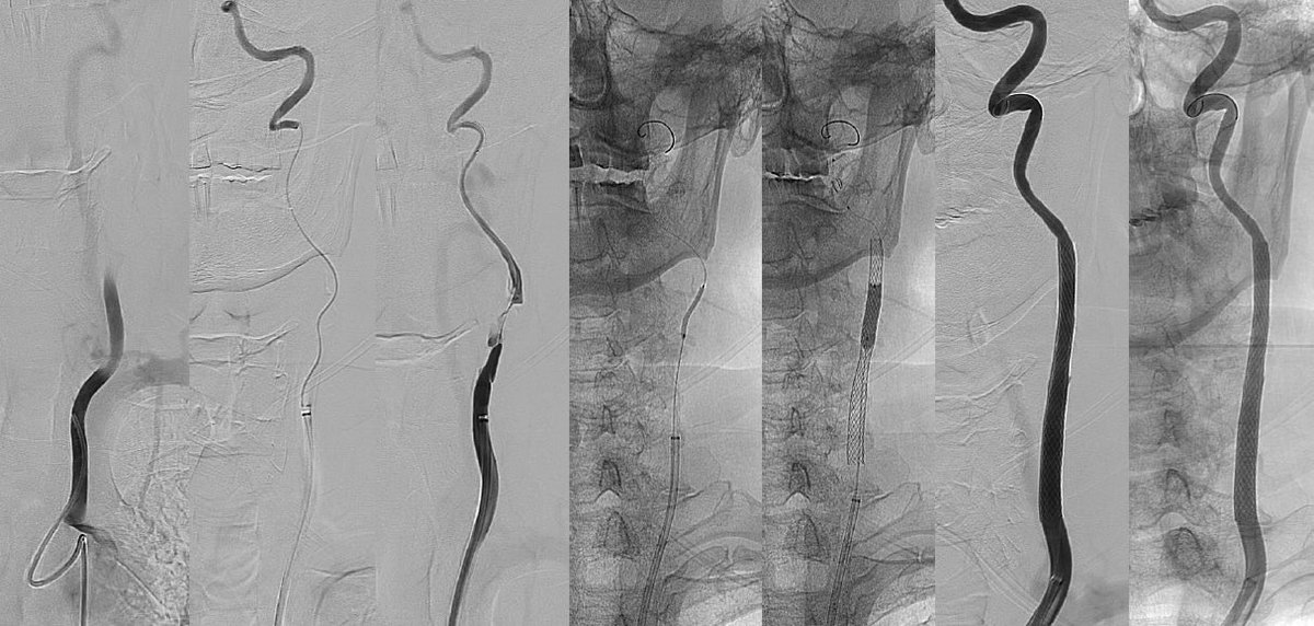 CarlosC74716941's tweet photo. Symptomatic occlusion of the common carotid artery.
A recanalization with angioplasty and stent placement was performed. Thanks @IsaRCaamano https://t.co/QNlGcI619n