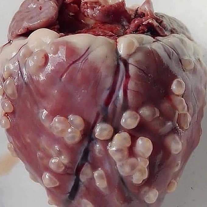 Cardiac cysticercosis