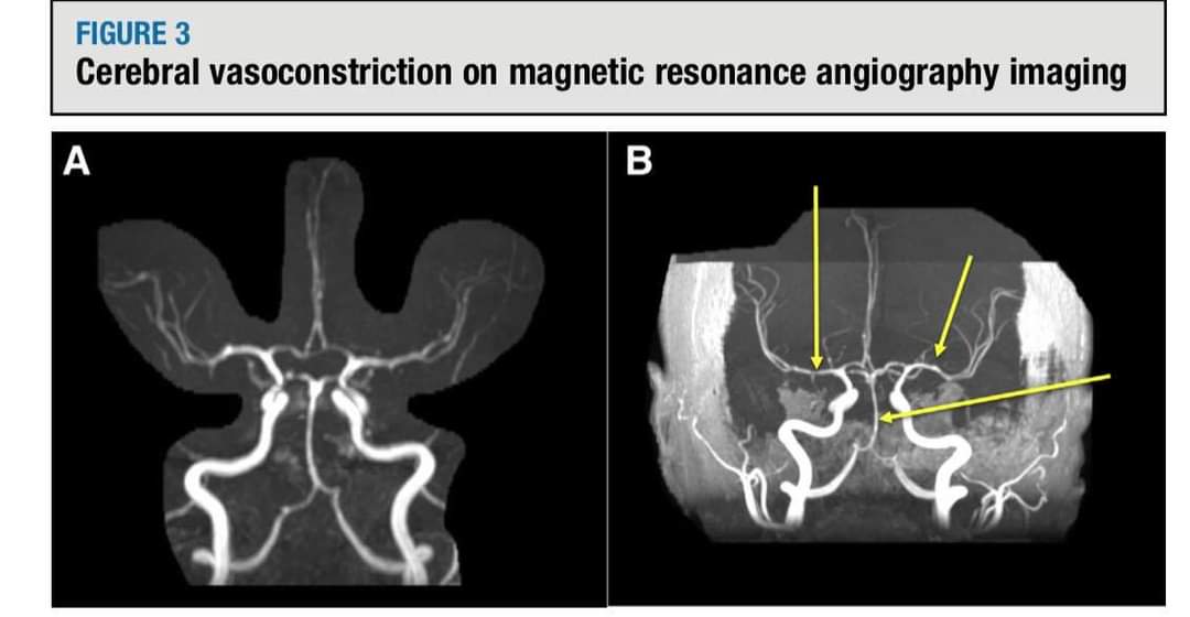 ECLAMPSIA🤰🏻 en el siglo XXI💫🫀
💥Lesiones cerebrales no son específicas;  lesión endotelial sistémica, microangiopatía trombótica, el sd urémico hemolítico atípico, la hipertensión maligna y sd anticuerpos antifosfolípidos.
ajog.org/article/S0002-…
🔑🔓
acrobat.adobe.com/link/track?uri…