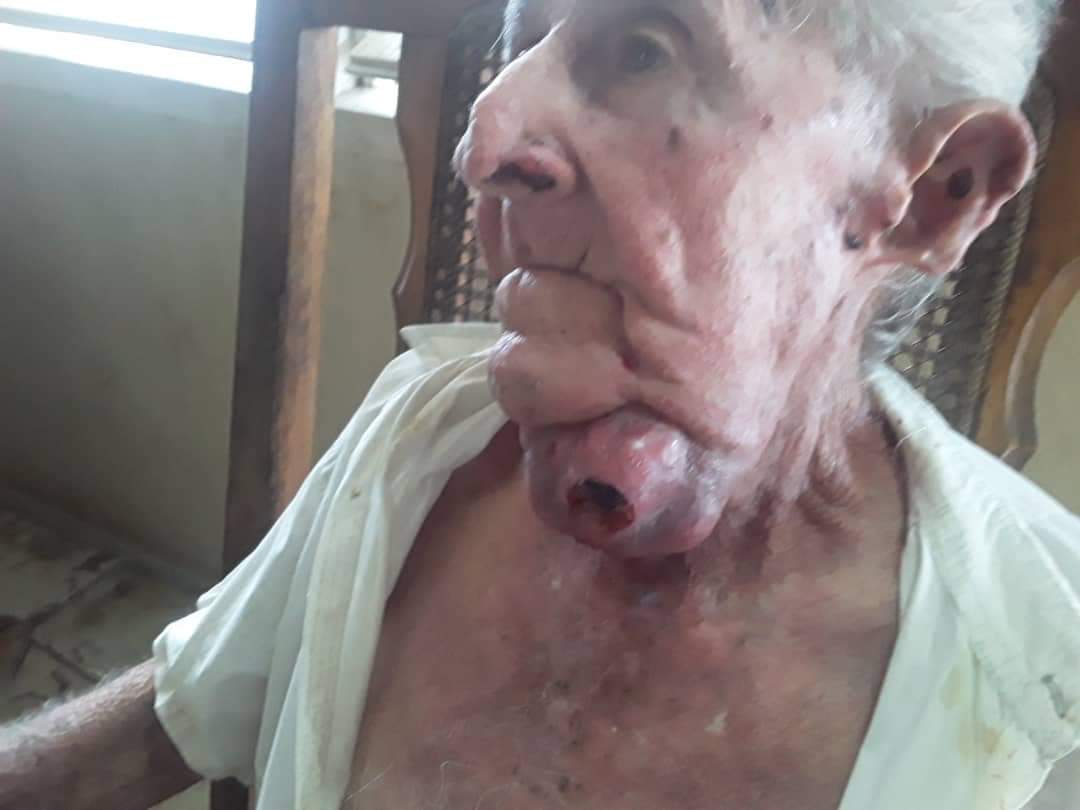 DoctorPatria's tweet photo. Este buen hombre es mi tío paterno tiene 85 años cumplidos y la mayor parte de su vida la dedicó a trabajar en la agricultura, específicamente como jefe de lote en el cultivo de caña, actividad a la que le dedicó sus mejores años, y lo hizo con empeño y honestidad. 
A mediados de diciembre se le formó un bultito debajo de la mandíbula izquierda, pasaron los días de fiestas y los feriados de enero y se llevó al médico al hospital viejo de Santa Clara, donde funciona el departamento de oncología, con la ayuda de Dios y del Dr Marvyn Rodríguez, el director y subdirector de este hospital se le pudieron hacer todos los exámenes necesarios, inclusive la biopsia, una hazaña para estos tiempos, pero resulta que en “la potencia médica” en Villa Clara no hay médicos maxilofaciales, necesarios para poder operar. 
Mis hermanos fueron al ministerio de salud provincial y el Dr Celestino los atendió, la respuesta de este señor parece sacada del programa “San Nicolás del Peladero”, este señor les dijo: “imagínense el imperialismo yanki nos ha robado nuestros talentos, además por más oscura que sea la noche siempre va a amanecer “
Este señor ignora que el grueso de los médicos cubanos están cumpliendo misiones en el extranjero, trabajando en una forma de esclavitud moderna, lo que le reporta a la dictadura excelentes dividendos, y que otros han encontrado actividades que les reportan mayores ganancias que su profesión, olvida que un médico especialista gana alrededor de 5,000 cup, mientras un policía que la mayoría de las veces no tienen ni un 9no grado de escolaridad ganan sobre los 10,000 cup, pero claro un médico sólo puede salvar vidas, pero un policía, si es medio tonto mejor, puede reprimir, puede incluso matar y eso es más necesario para el régimen que tener disponibles los médicos a los que se les pague adecuadamente, médicos satisfechos que no tengan necesidad de cambiar su profesión, medicos que al mirar sus pacientes no tengan que decirles que no tienen los medicamentos necesarios ni tan siquiera materiales de curación, médicos que en algunas ocasiones son el blanco de la frustración de pacientes y familiares y esto no es culpa del imperio, es culpa absoluta del mal gobierno, de la ineptitud de sus dirigentes.
Lo qué pasa con mi tío es una constante en los hospitales de todo el país, porque los cubanos de a pie se han convertido en desechables, lo que le sucede hoy a él , podría sucederle a tu papá, tu hermano, tu hijo, a cualquier ser querido. 
Al Dr Celestino, sólo quiero decirle que hasta los veterinarios deben sentir empatía y amor por los animales.
#CubaEstadoFallido