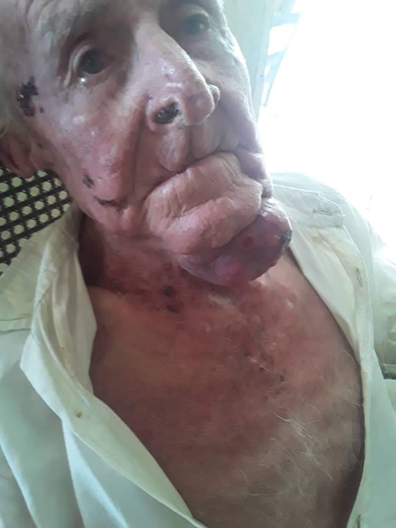 DoctorPatria's tweet photo. Este buen hombre es mi tío paterno tiene 85 años cumplidos y la mayor parte de su vida la dedicó a trabajar en la agricultura, específicamente como jefe de lote en el cultivo de caña, actividad a la que le dedicó sus mejores años, y lo hizo con empeño y honestidad. 
A mediados de diciembre se le formó un bultito debajo de la mandíbula izquierda, pasaron los días de fiestas y los feriados de enero y se llevó al médico al hospital viejo de Santa Clara, donde funciona el departamento de oncología, con la ayuda de Dios y del Dr Marvyn Rodríguez, el director y subdirector de este hospital se le pudieron hacer todos los exámenes necesarios, inclusive la biopsia, una hazaña para estos tiempos, pero resulta que en “la potencia médica” en Villa Clara no hay médicos maxilofaciales, necesarios para poder operar. 
Mis hermanos fueron al ministerio de salud provincial y el Dr Celestino los atendió, la respuesta de este señor parece sacada del programa “San Nicolás del Peladero”, este señor les dijo: “imagínense el imperialismo yanki nos ha robado nuestros talentos, además por más oscura que sea la noche siempre va a amanecer “
Este señor ignora que el grueso de los médicos cubanos están cumpliendo misiones en el extranjero, trabajando en una forma de esclavitud moderna, lo que le reporta a la dictadura excelentes dividendos, y que otros han encontrado actividades que les reportan mayores ganancias que su profesión, olvida que un médico especialista gana alrededor de 5,000 cup, mientras un policía que la mayoría de las veces no tienen ni un 9no grado de escolaridad ganan sobre los 10,000 cup, pero claro un médico sólo puede salvar vidas, pero un policía, si es medio tonto mejor, puede reprimir, puede incluso matar y eso es más necesario para el régimen que tener disponibles los médicos a los que se les pague adecuadamente, médicos satisfechos que no tengan necesidad de cambiar su profesión, medicos que al mirar sus pacientes no tengan que decirles que no tienen los medicamentos necesarios ni tan siquiera materiales de curación, médicos que en algunas ocasiones son el blanco de la frustración de pacientes y familiares y esto no es culpa del imperio, es culpa absoluta del mal gobierno, de la ineptitud de sus dirigentes.
Lo qué pasa con mi tío es una constante en los hospitales de todo el país, porque los cubanos de a pie se han convertido en desechables, lo que le sucede hoy a él , podría sucederle a tu papá, tu hermano, tu hijo, a cualquier ser querido. 
Al Dr Celestino, sólo quiero decirle que hasta los veterinarios deben sentir empatía y amor por los animales.
#CubaEstadoFallido