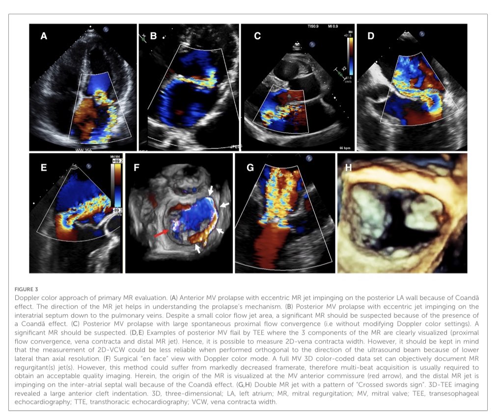 Quantification of primary mitral regurgitation by echocardiography: A practical appraisal.  dx.doi.org/doi:10.3389/fc…
#echofirst #mitral #CardioEd #POCUS #3DTEE