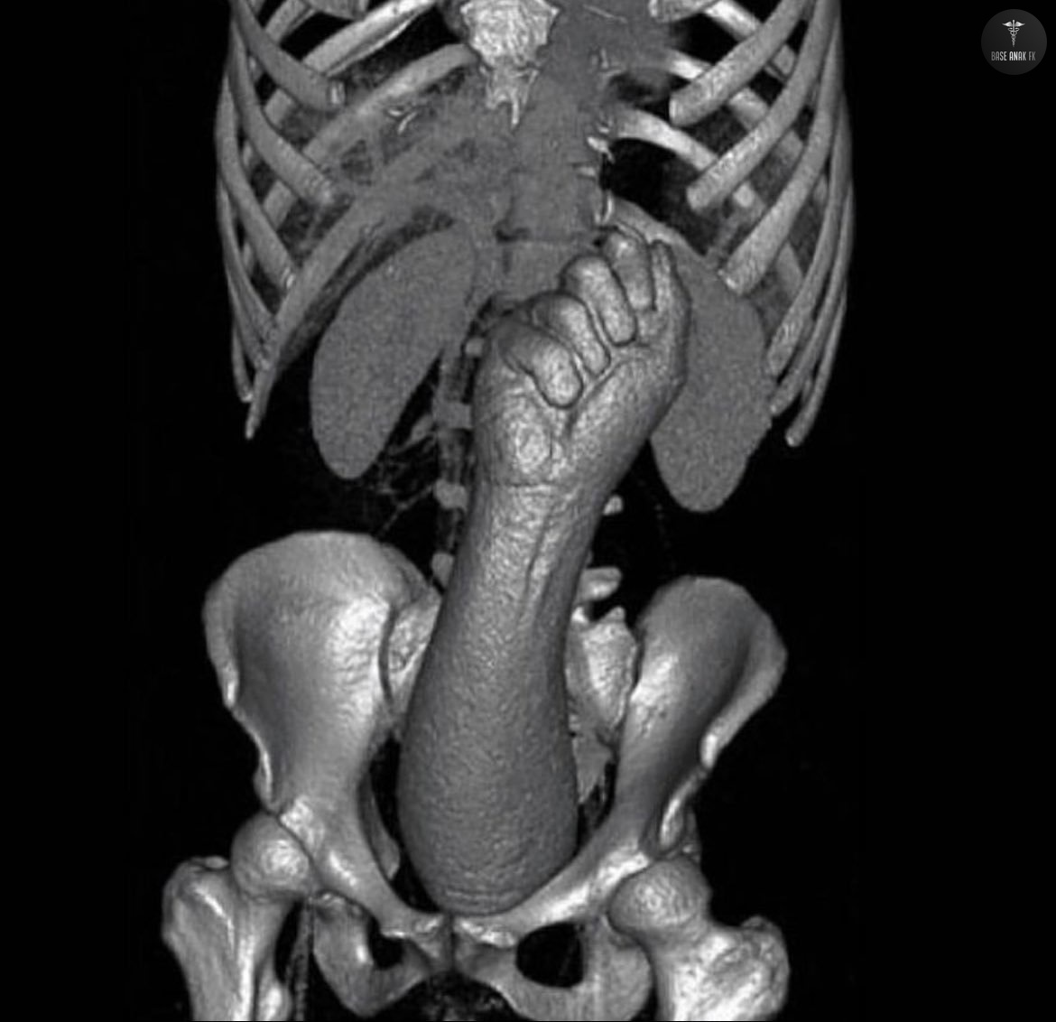 BaseAnakFK's tweet photo. Silikon berbentuk tangan "terjebak" di tubuh seorang pria dengan panjang 38x10cm dok 😭
Src: medicaltalks https://t.co/QwX4CPsmcv