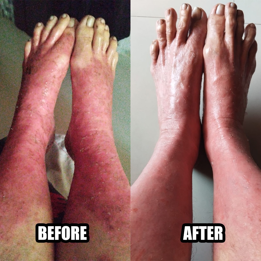 RedikallHealing's tweet photo. Redikall works amazingly well for several psycho-somatic illnesses. 

Here is a case presentation by one of our senior workshop participants from Spain, Ms. Sharda Mitchandani 

#redikall #redikallhealing #redikallinsights https://t.co/qPzFjQuGRm