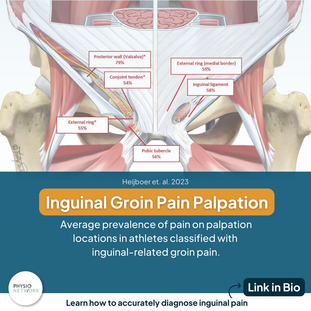 PhysioNetwork's tweet photo. 🔍 Diagnosing groin pain related to the inguinal area is difficult, but a recent study by Heijboer et al. 2023 (open access) looked at the accuracy of clinical tests.

 ⬇️ Check out our review by @alisongrimaldi here:

🔗 https://t.co/L2CcDkxrbo https://t.co/AFRM9N5KPo