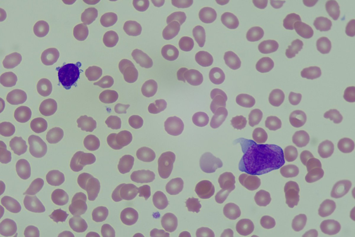 diff_discussion's tweet image. Next we review a slide of Acute Promyelocytic Leukemia (APL) microgranular variant youtu.be/sbJaUTCU05c