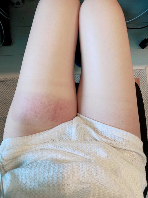 今日初めて前腿脂肪冷却した脚カワイソス https://t.co/6jEZCW6V4L<a href="/tag/%E3%81%8B%E3%81%AA%E3%81%88%E5%85%88%E7%94%9F%E3%81%8B%E3%82%89%E3%81%AE%E5%AE%BF%E9%A1%8C"class="tags"><span>#かなえ先生からの宿題</span></a>