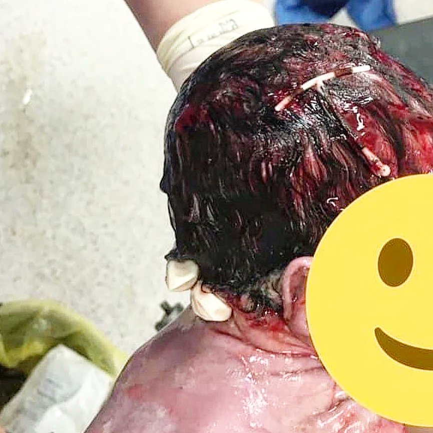 Benda yang bentuknya seperti huruf T besar itu adalah Intra Uterine Device (IUD) yang terkenal di Indonesia dengan nama Spiral (alat KB).

Alat ini sangat efektif mencegah 99% kehamilan.

Jadi bayi ini adalah sang 1%. 🫡🙌👏🏼👏🏼