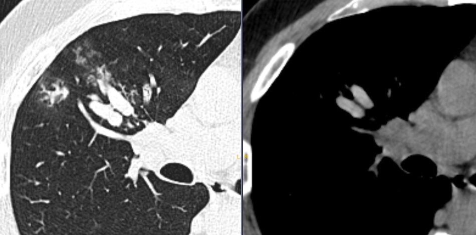 draceciferrario's tweet photo. Time for a Classic CT finding ✅
40 yo ♂️ with chronic cough
Asthma and blood eosinophilia🩸

#radtwitter #radiology
#radres #MedTwitter #chestrad https://t.co/Q9cHoClg7x
