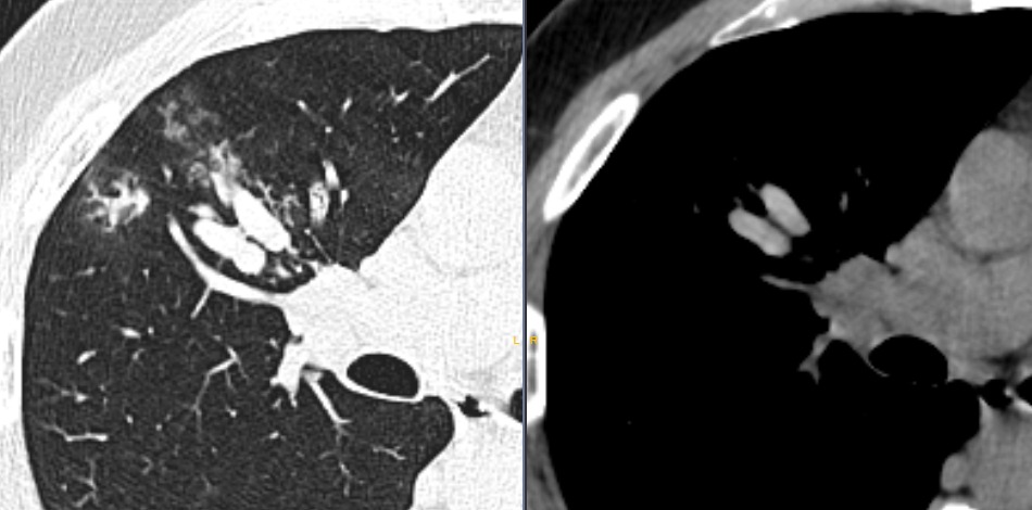 Time for a Classic CT finding ✅
40 yo ♂️ with chronic cough
Asthma and blood eosinophilia🩸

#radtwitter #radiology
#radres #MedTwitter #chestrad